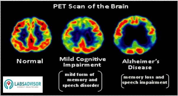PET Brain Scan uses - India!