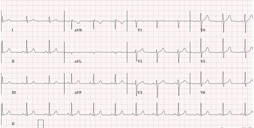 This is an image of an ECG report.