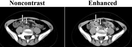 Difference between CT Scan With Contrast and without Contrast