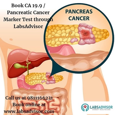 Image shows the exact location of pancreatic cancer.