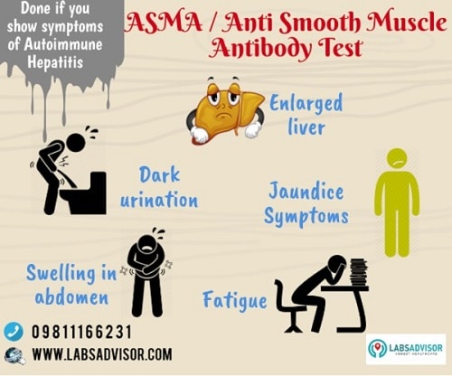 ASMA is associated with liver disease and autoimmune hepatitis.