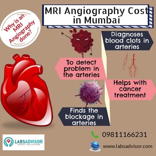 Reasons for taking an MRI Angiography or MRA Scan!