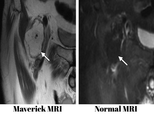 Mavric MRI is an effective tool to examine the areas near the metal implants.