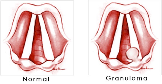Normal and Granuloma.
